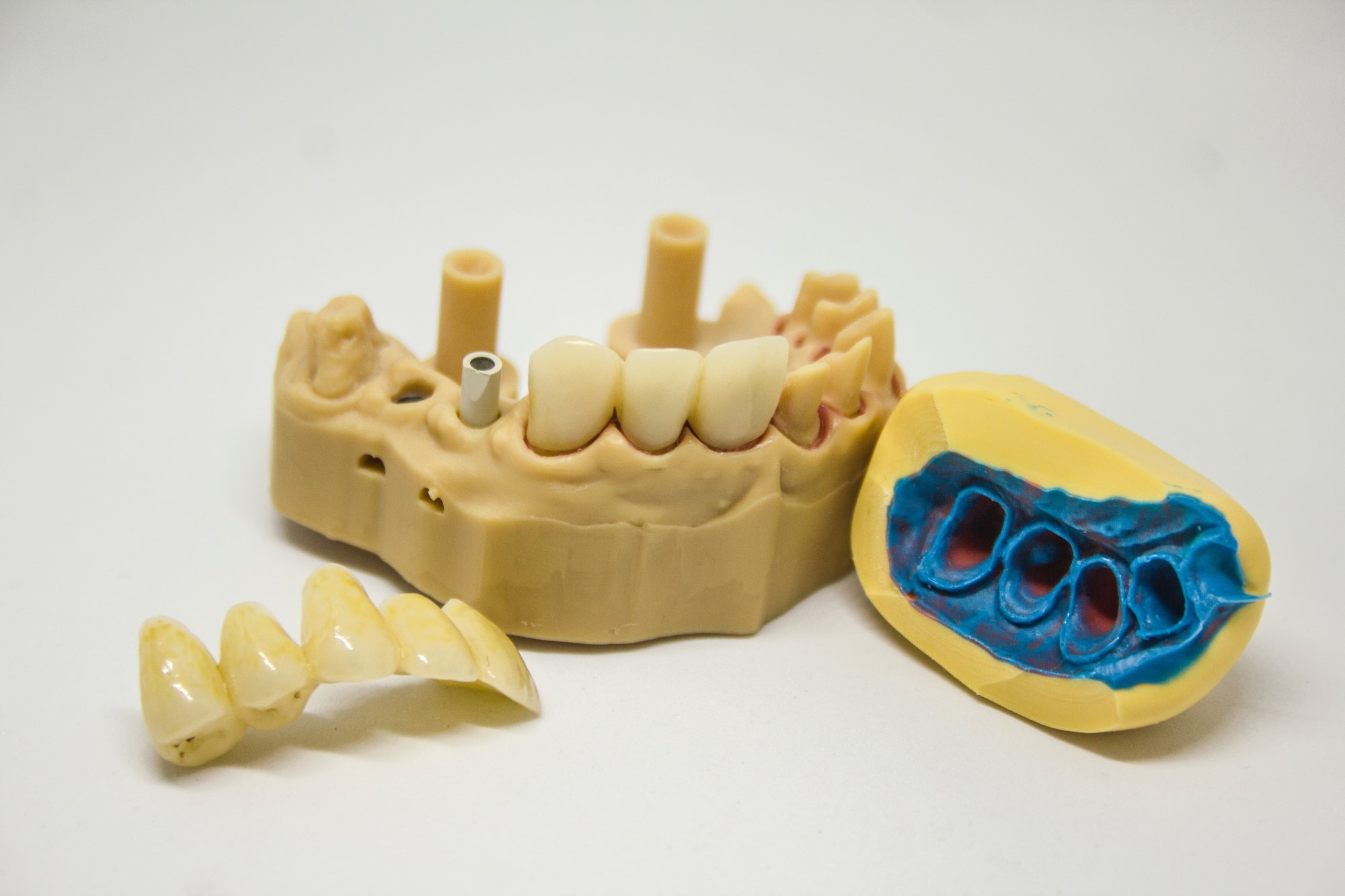 dental implants