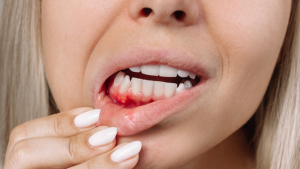 early-signs-of-gum-disease
